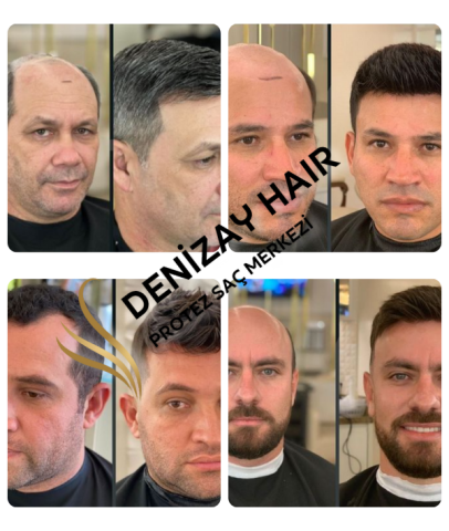 Denizay Hair Protez Saç Merkezi görseli
