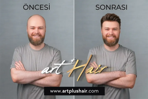 Atro Protez Saç görseli