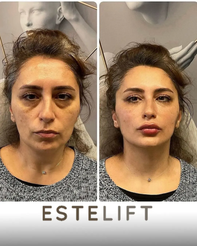 Estpoint | Estelift görseli